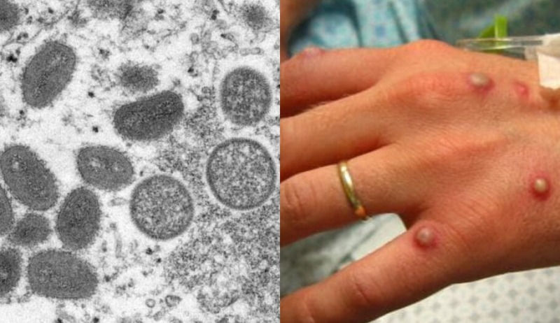 Após Europa, Estados Unidos confirmam primeiro caso de “varíola dos macacos”